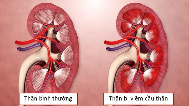 Điều trị đái buốt ra máu bằng thuốc