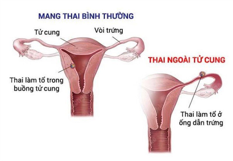 Sự khác biệt giữa 2 cách mang thai