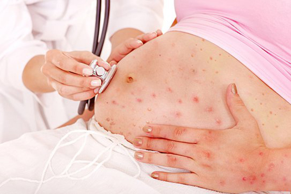 Khi mang thai, mẹ mắc bệnh rubella