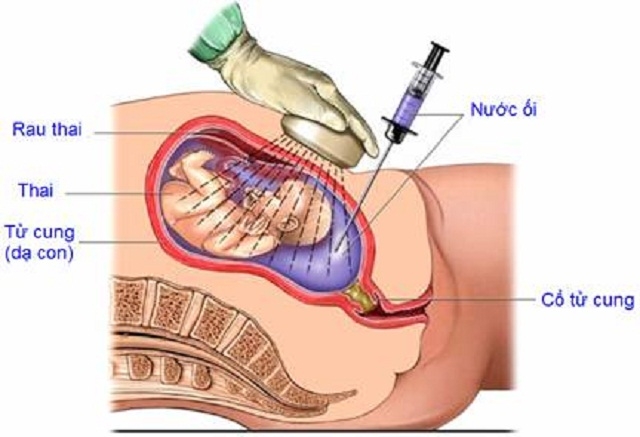 chẩn đoán trước sinh