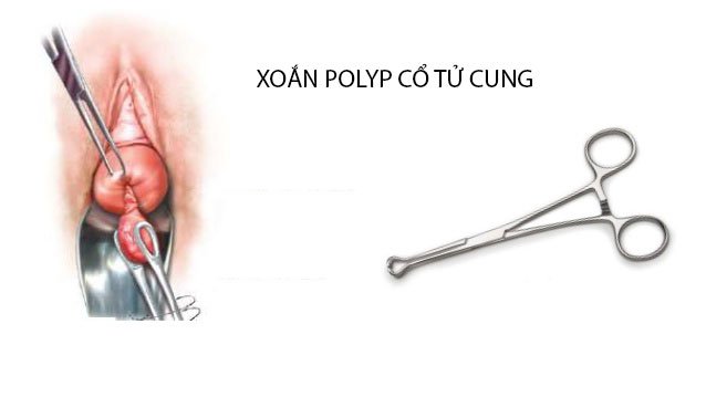 Xoắn Polyp Cổ Tử Cung Kiêng Ăn Gì? Hướng Dẫn Chi Tiết Sau Phẫu Thuật