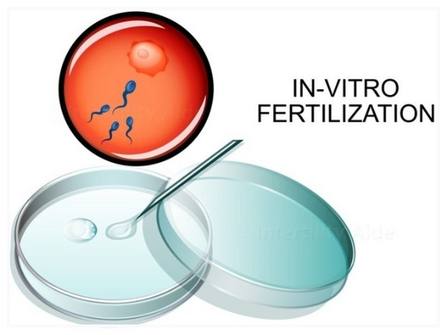 IVF là gì? Tìm hiểu về phương pháp thụ tinh nhân tạo