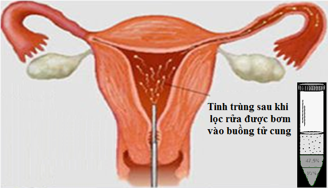 Làm IUI là gì? Tất tần tật những điều cần biết về phương pháp IUI